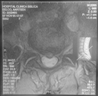 MRI Dwars Slice 8 9