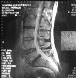 Central L5-S1 Lumbar Disk Hernia